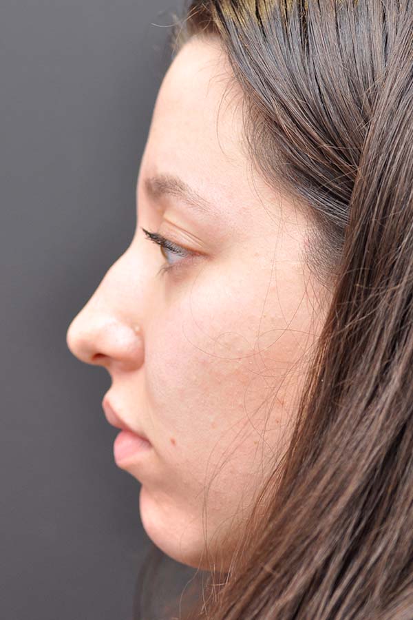 Rhinoplasty Before and After | Northside Plastic Surgery