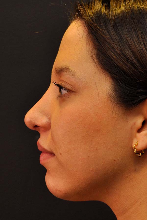 Rhinoplasty Before and After | Northside Plastic Surgery