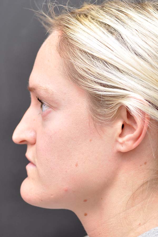 Rhinoplasty Before and After | Northside Plastic Surgery