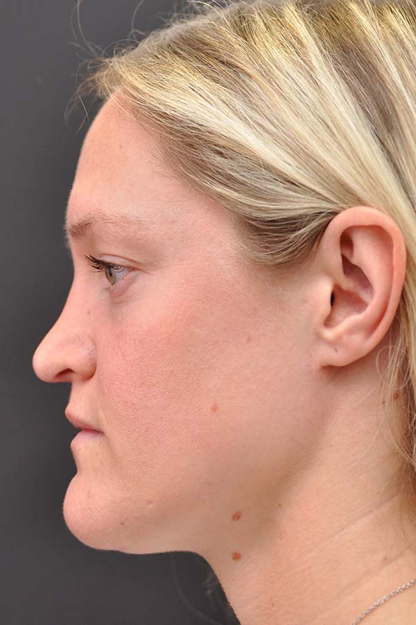 Rhinoplasty Before and After | Northside Plastic Surgery